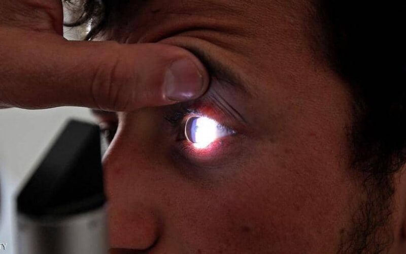 الأطباء يحذرون اصفرار العين ربما دل على امراض خطيرة