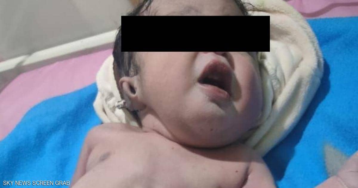"من دون بطن".. تفاصيل ولادة "ووفاة" طفل بحالة نادرة في مصر