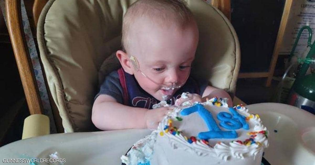الطفل المعجزة.. أصغر "مبستر" بالعالم يحتفل بعيد ميلاده الأول