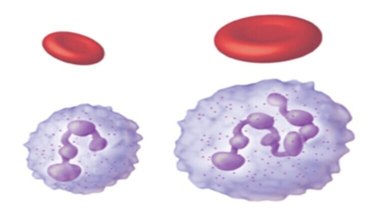 فقر الدم ضخم الأورمات الناتج عن نقص فيتامين ب12او حمض الفوليك.