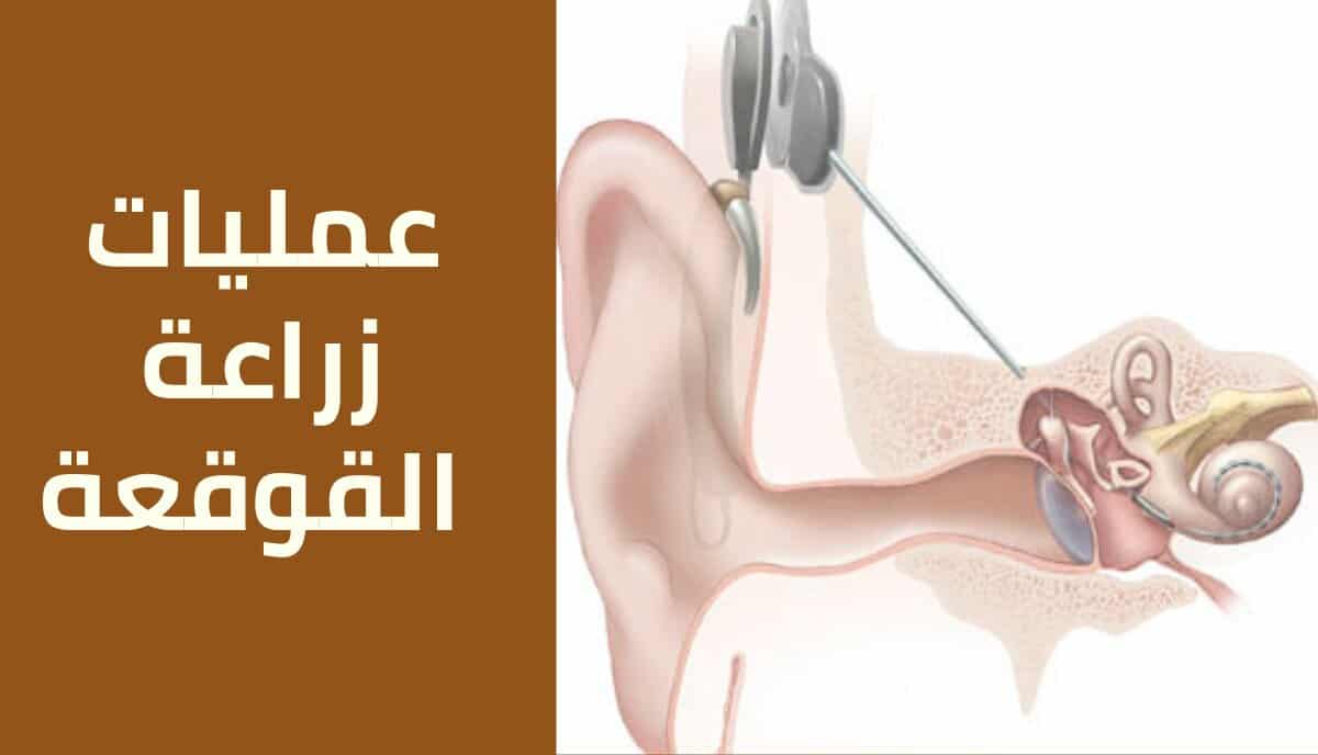 عمليات زراعة القوقعة للأذن وكل ما يلزم معرفته